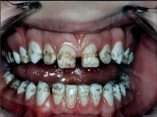 Флюороз - отложение фтора на эмали зубов